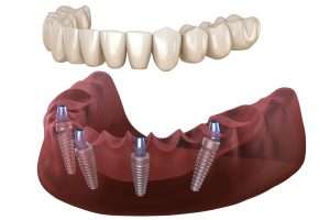 Allon4 Dental Prosthesis