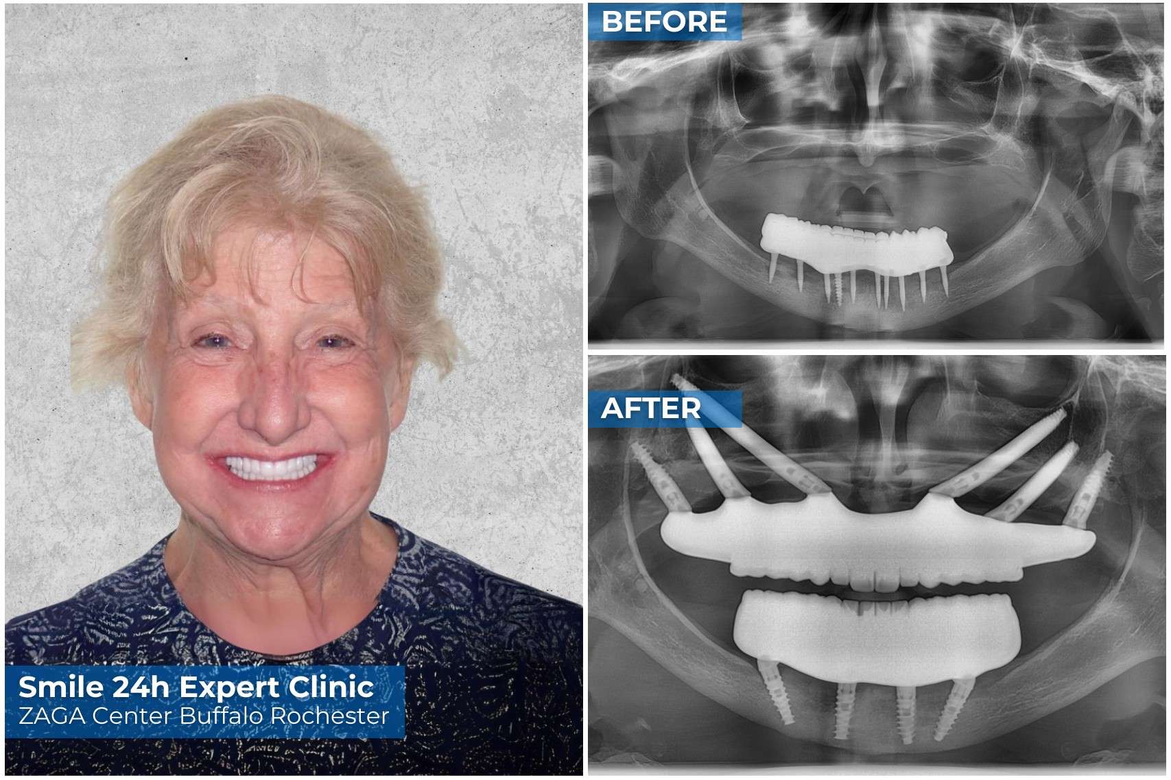 Before After Zygomatic Pterygoid