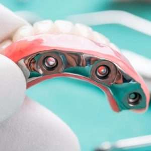 Complete Denture