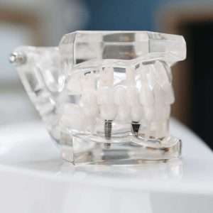 Dental Implant Model Mouth