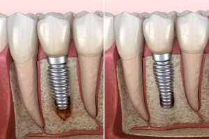 Dental Implant Osseointegration