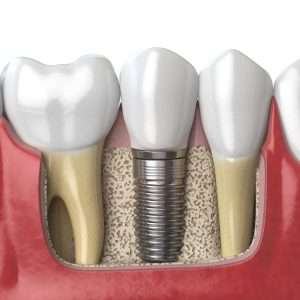 Dental Implant Schematic