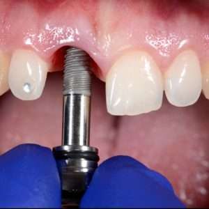 Implant Placement