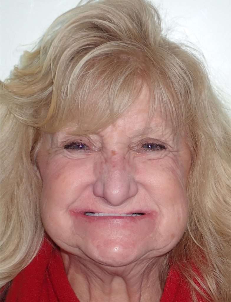Tammy Before Implants