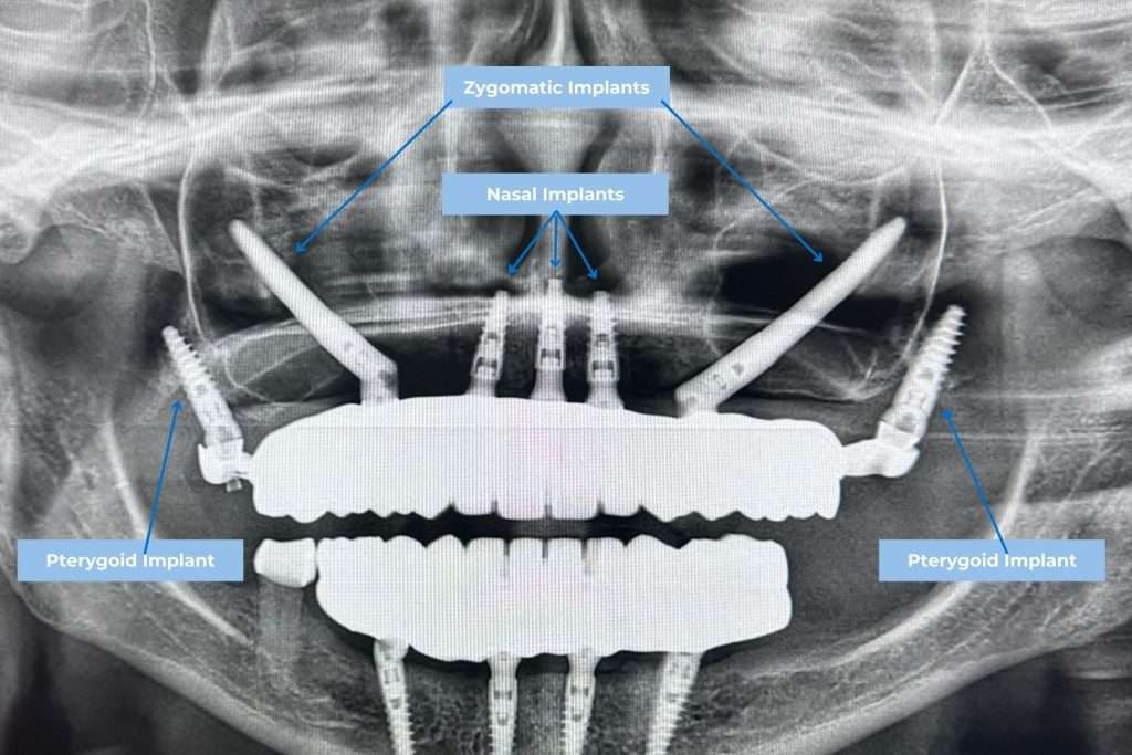 Implantes dentários no maxilar superior