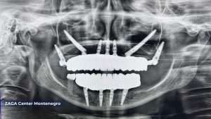 XRay Zygomatic Rehabilitation