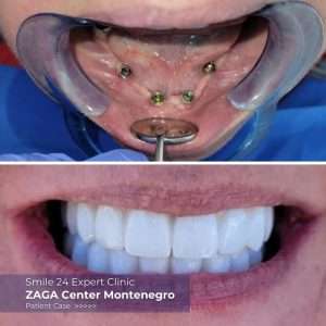 before after dentures