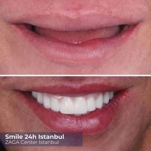 before after istanbul