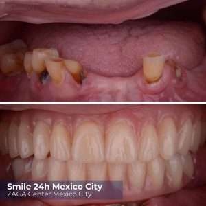 Before and after dental implants Mexico City