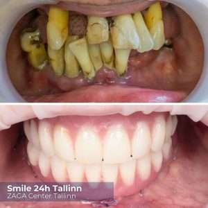 Before and after dental implants Tallinn Estonia