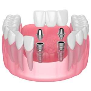 dental bridge illustration