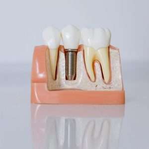 Dental implant schematic view showing crown abutment and implant