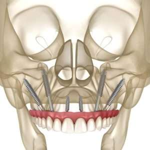 zygomatic implants 3d view