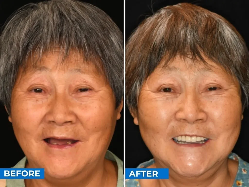 Before After Beijing Before After Beijing