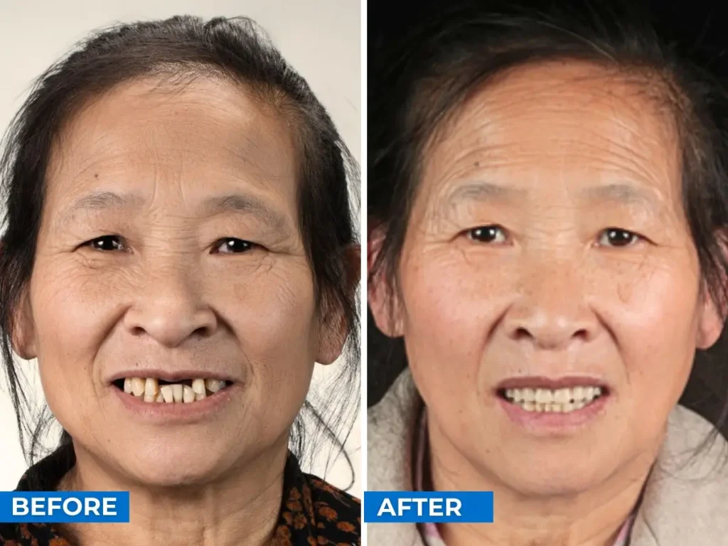 Before After Beijing 2 Before After Beijing 2
