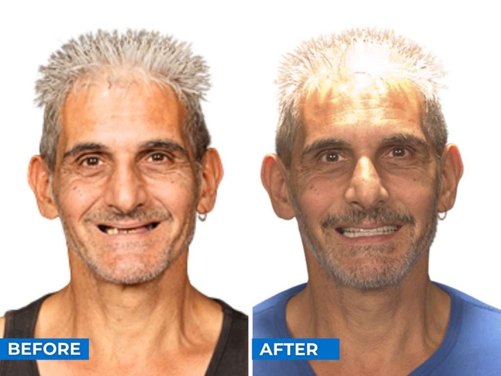 Before After Melbourne 3