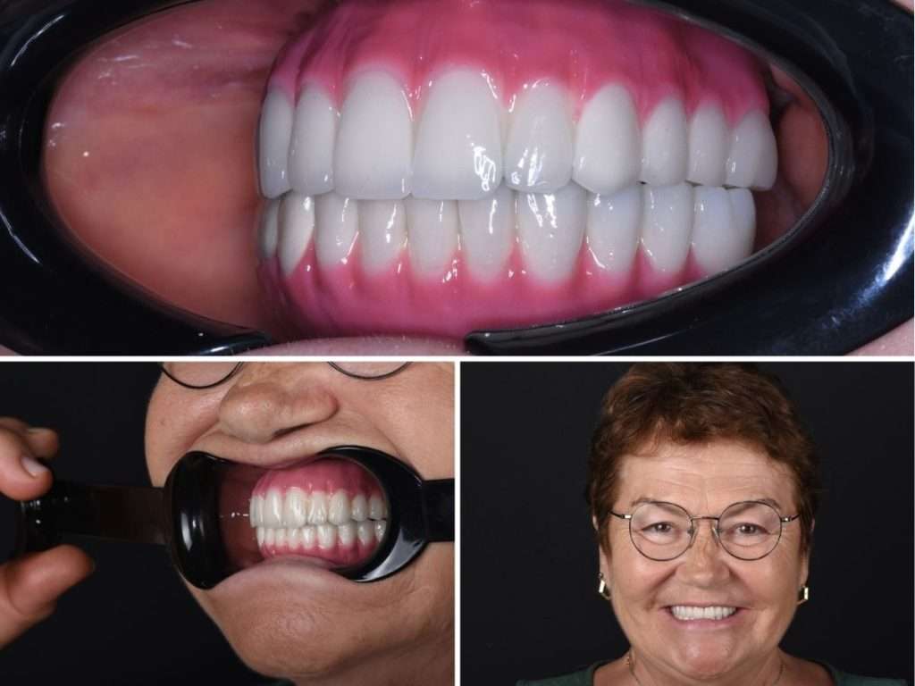 Melek's smile transformation