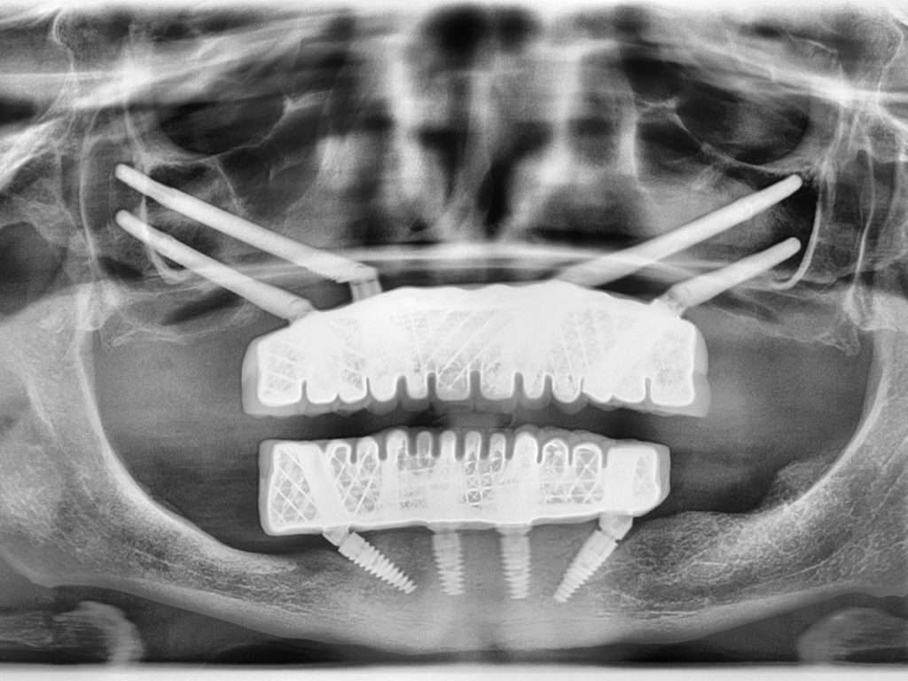 Zygomatic implants before and after patient Melek