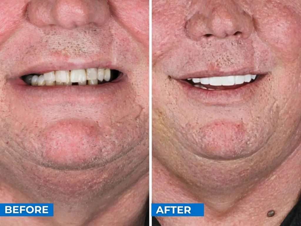 before after cancun