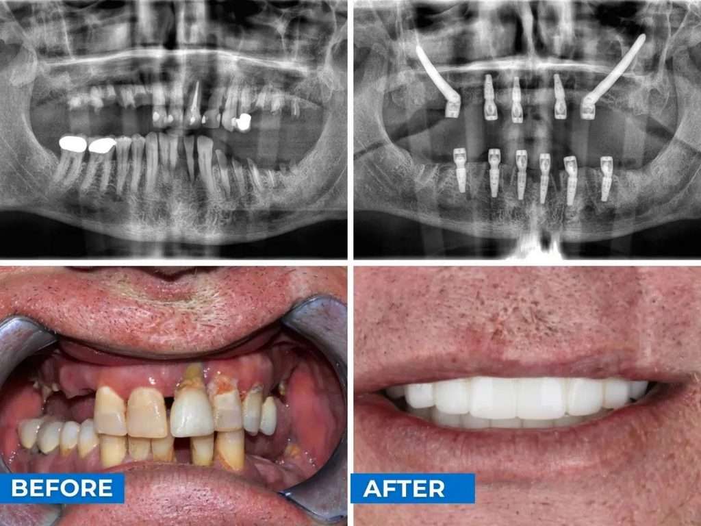 before after cancun 2