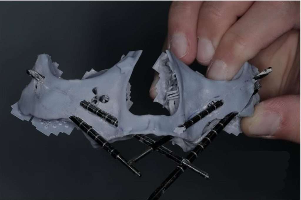 zygomatic surgery planning